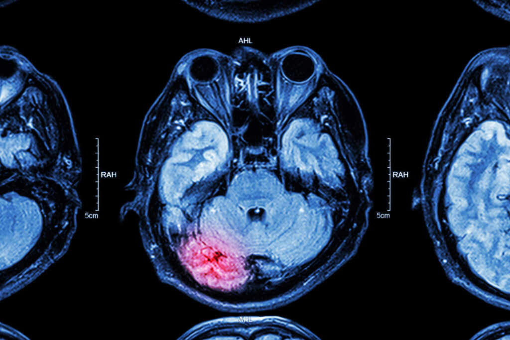 Brain Injury 